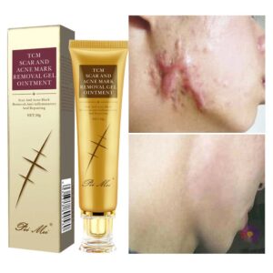 MSLAM Skin Care Acne Scar Removal Cream Gel Face Pimples Stretch Marks Cream Repairing Smoothing Moisturizing Body Cream 30g