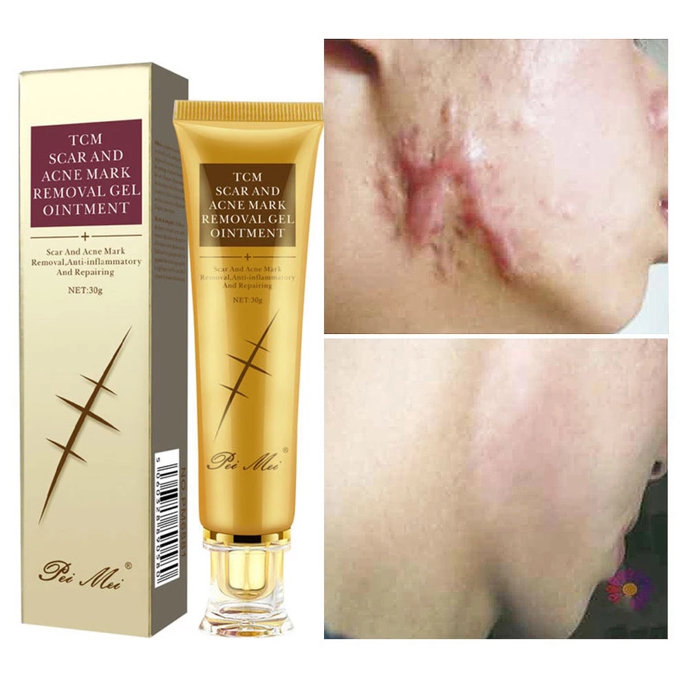 MSLAM Skin Care Acne Scar Removal Cream Gel Face Pimples Stretch Marks Cream Repairing Smoothing Moisturizing Body Cream 30g