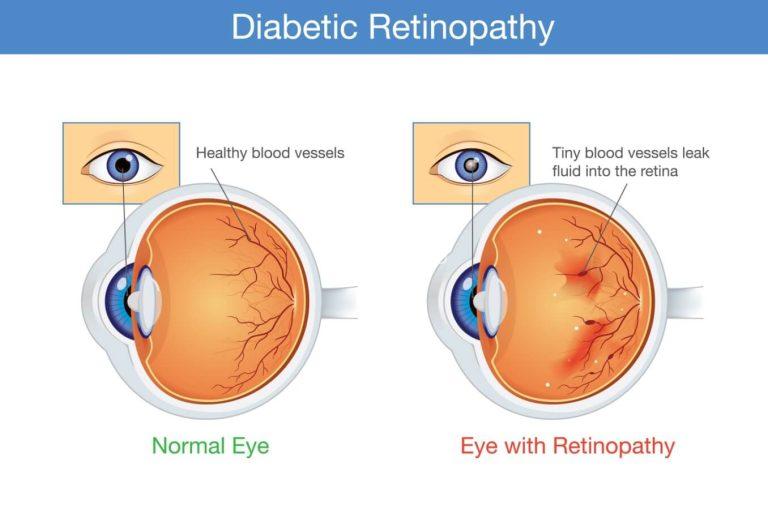 Does Diabetes Cause Red Eyes? Exploring the Link!